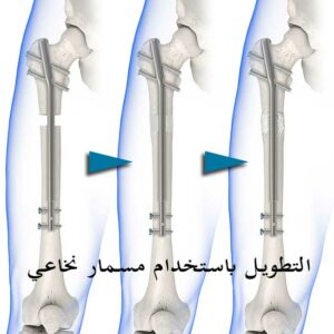 تجربتي مع المسمار النخاعي