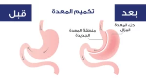 سعر عملية تكميم المعدة