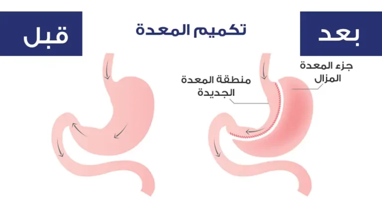 سعر عملية تكميم المعدة