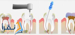 طريقة إجراء عملية سحب عصب الاسنان