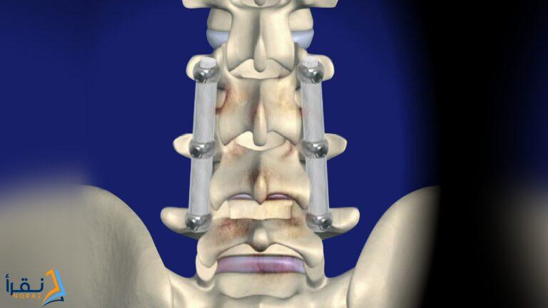 سعر عملية تثبيت الفقرات